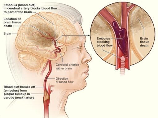 Carotid Artery Disease Vascular Care Center