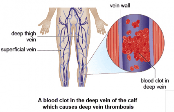 Deep vein thrombosis - Vascular care center