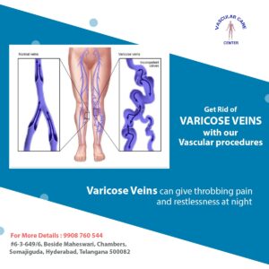 varicose veins treatment in hyderabad