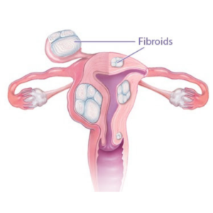 Best Uterine fibroids Treatment in Hyderabad