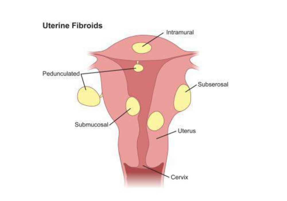 Uterine fibroids Treatment in Hyderabad